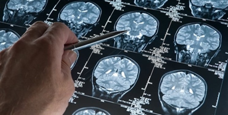 درمان اختلالات پس از سکته مغزی باید بلافاصله آغاز شود